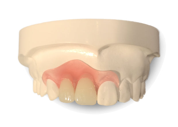 Flipper | Partial Denture