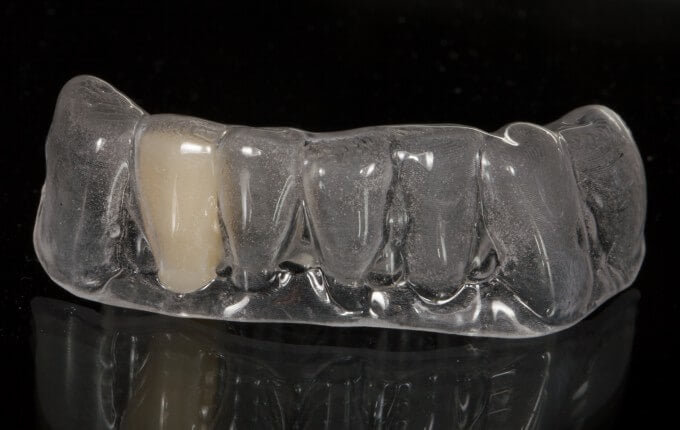 Clear Essix Pontic Retainer