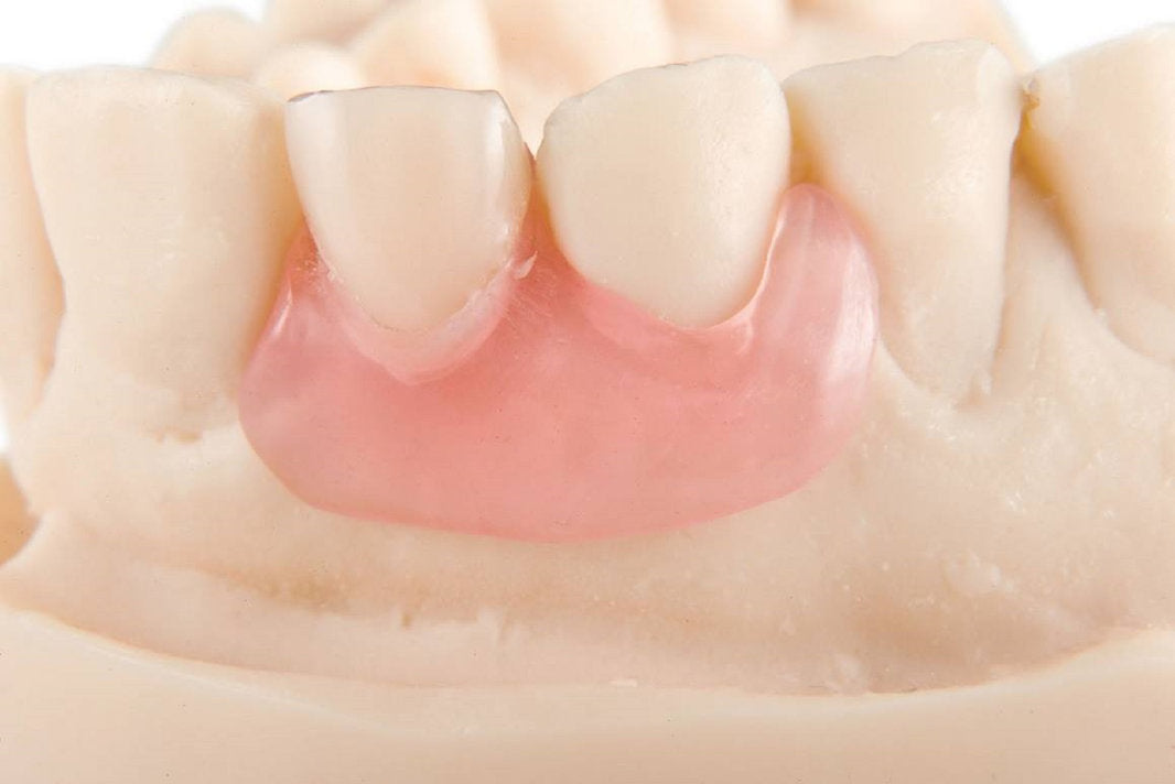 Flipper Partial Denture Direct Dental Prosthetics