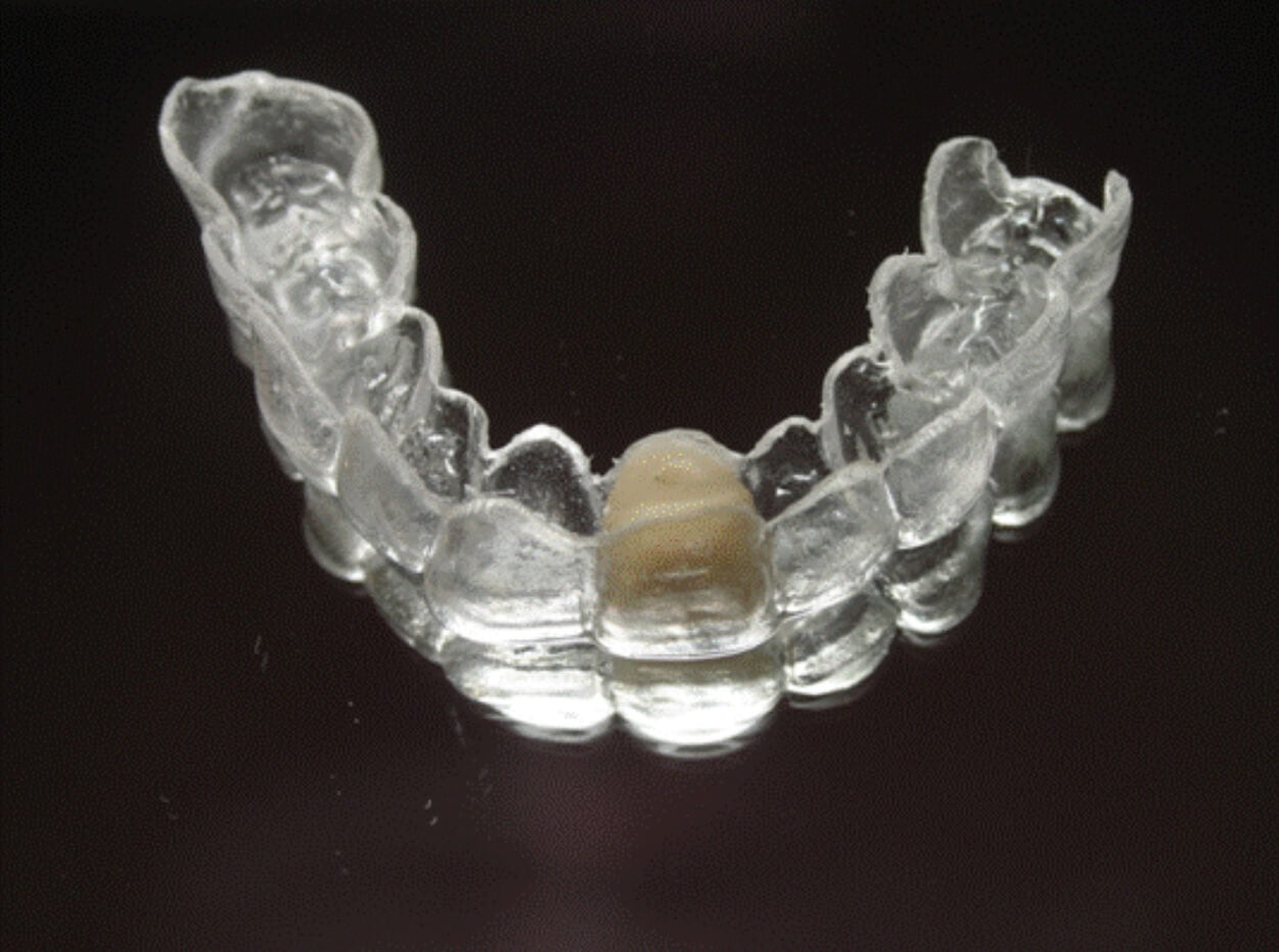 Clear Essix Pontic Retainer – Direct Dental Prosthetics