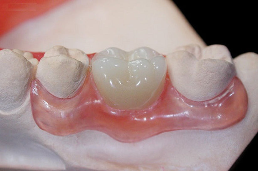 Nesbit Partial Denture Direct Dental Prosthetics